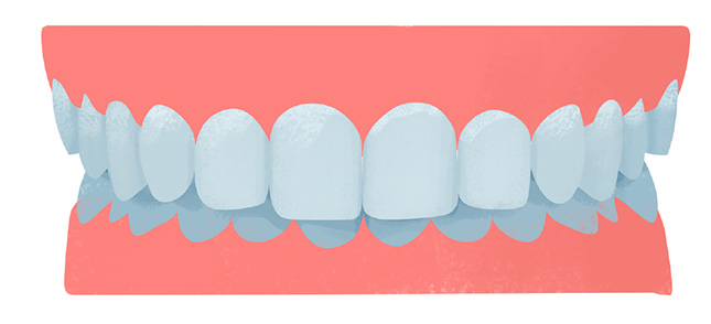 Malocclusions dentaires de classe 2 ou rétrognathies mandibulaires